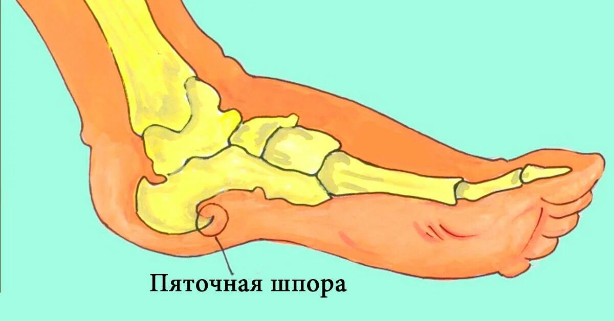 Как выглядит шпора у детей