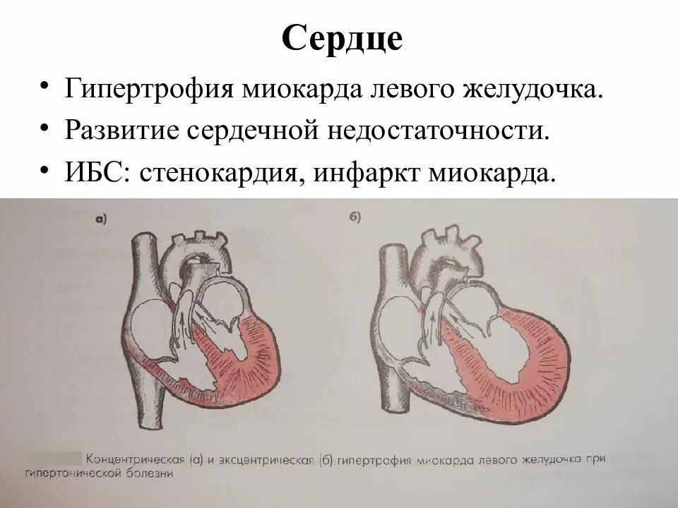 Гипертрофия полостей сердца. Эксцентрическая гипертрофия сердца. компенсаторная гипертрофия левого желудочка. концентрическая гипертрофия миокарда. гипертрофия миокарда левого желудочка сердца что это такое.