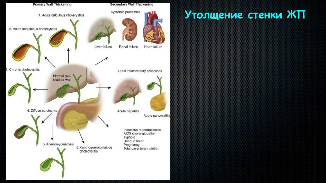 Деформация желчного пузыря симптомы. Деформация желчного пузыря на кт. Перегиб желчного пузыря в средней трети. Позиционная деформация желчного пузыря что это такое. Эхо признаки желчного пузыря