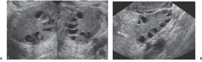Мультифолликулярные поликистоз яичников. Мультифолликулярные яичники на УЗИ. Мультифолликулярный поликистоз яичников. Поликистозный яичник на УЗИ. Мфя в гинекологии что