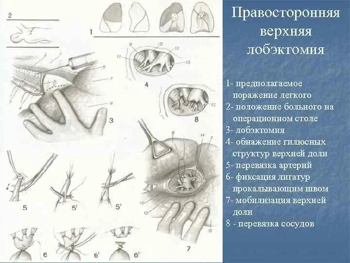 Лобэктомия топографическая анатомия. Положение на операционном столе при различных операциях. Протокол операции лобэктомия легкого. Правосторонняя лобэктомия. Лобэктомия что это