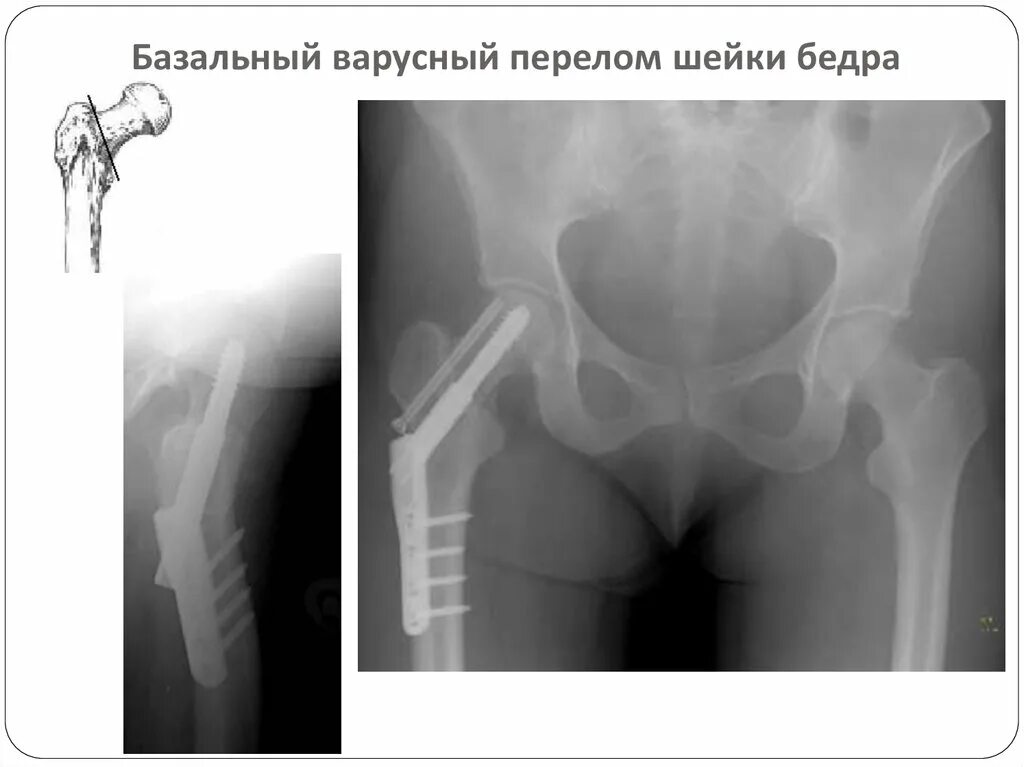 вколоченный перелом шейки бедренной кости. субкапитальный перелом бедра. перелом шейки бедра рентген. базальный перелом бедра. базальный перелом шейки бедренной кости.