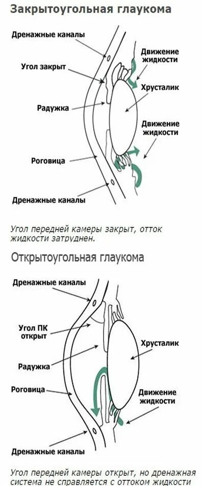 Открытоугольная форма глаукомы. Первичная открытоугольная глаукома симптомы. Схема открытоугольной и закрытоугольной глаукомы. Патогенез первичной закрытоугольной глаукомы.