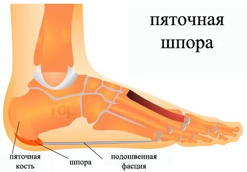 Шпоры причина появления. Пяточные шпоры симптомы.