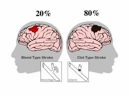 Stroke перевод