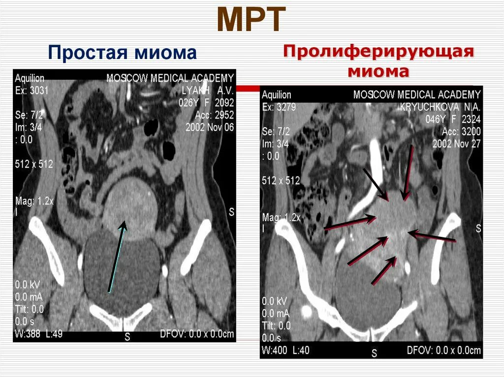 Эко при миоме матки. Пролиферирующая миома мрт. субмукозная миома матки мрт.
