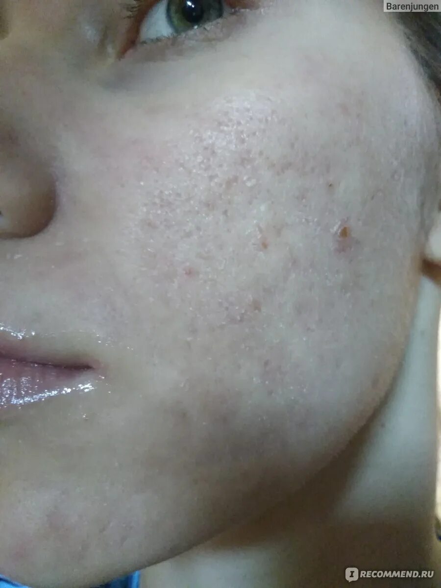 Акнекутан отзывы до и после Дерматотропные средства Hoffmann-La Roche Роаккутан (изотретиноин) "Я не выход