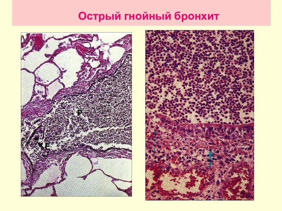 Бронхи гной. Острый бронхит мокрота. Острый гнойный трахеобронхит. Закупорка бронха слизью. Хронический бронхит с мокротой кашлем.
