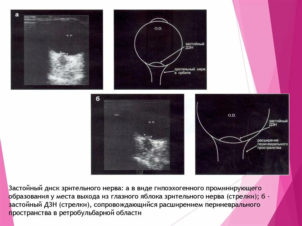 Периневральное пространство зрительного нерва. Расширение субарахноидального пространства зрительного нерва. Зрительный нерв норма УЗИ. Отек диска зрительного нерва УЗИ.