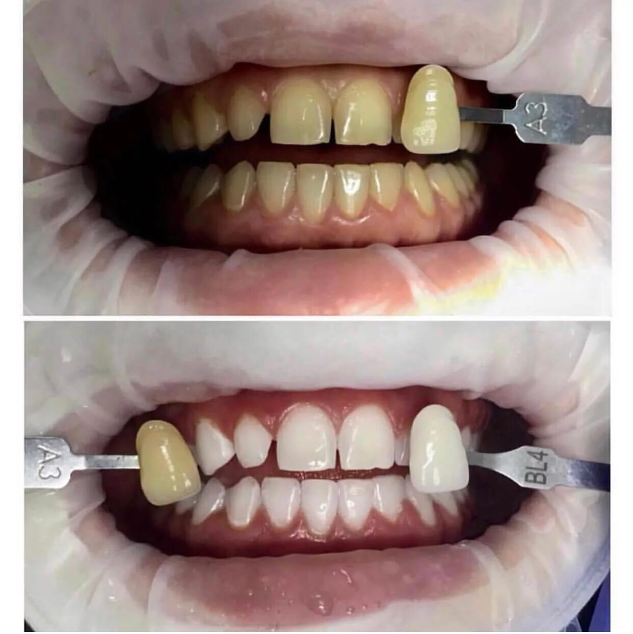 Чистка зубов улан удэ. Отбеливание зоом 4 до и после. Зубы до и после отбеливания.