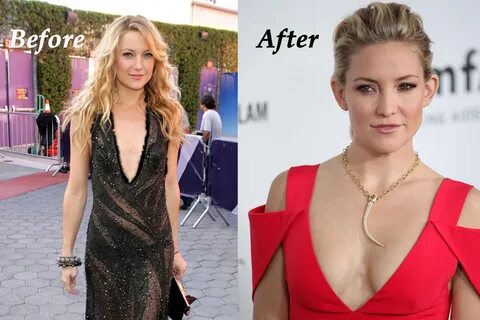 Kate hudson boob job