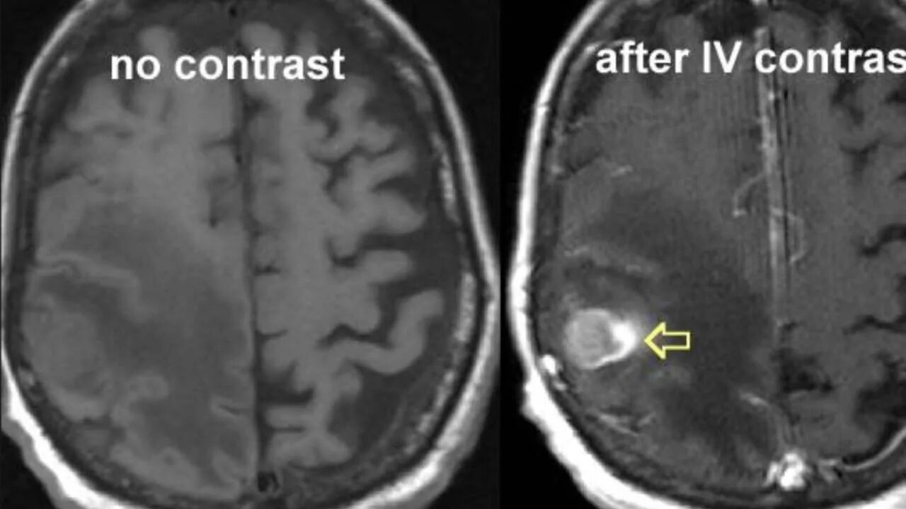Мрт с контрастом головного. Опухоль головного мозга мрт с контрастом. Опухоль мозга мрт с контрастом. Что такое контрастирование при мрт головного мозга. Мрт головного мозга без контраста.