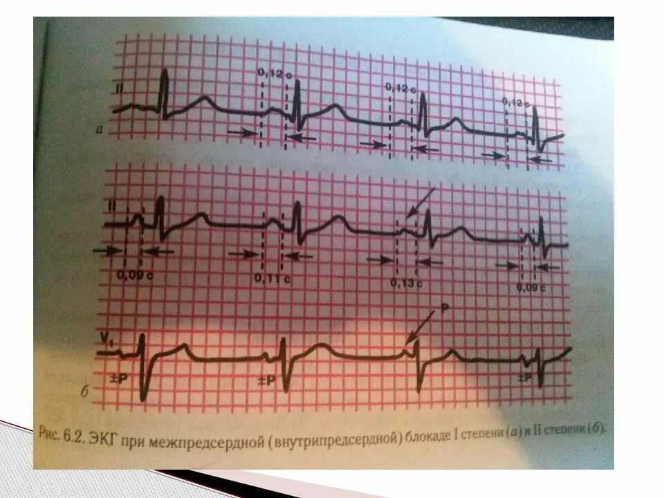 Что значит внутрипредсердная внутрипредсердная блокада. Внутрипредсердная блокада на ЭКГ. Межпредсердная блокада 2 степени ЭКГ. Внутрипредсердные блокады на ЭКГ. Полная внутрипредсердная блокада.