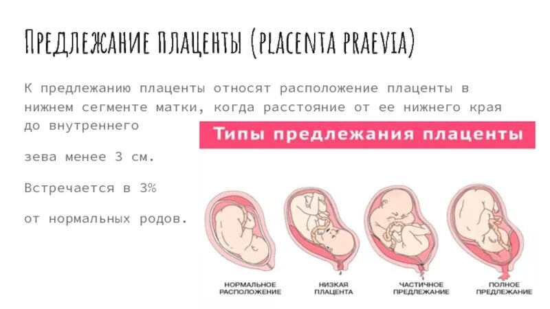 Матка на 21 неделе беременности