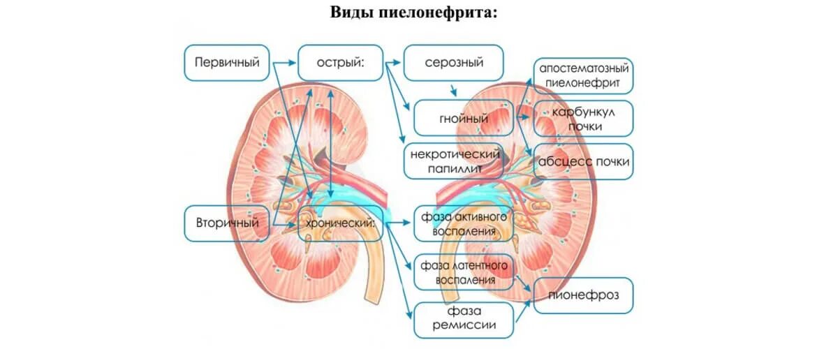 Причины пиелонефрита почек. Острый вторичный пиелонефрит симптомы. Тип воспаления острый пиелонефрит. Формы пиелонефрита у детей. Строение почки пиелонефрит.