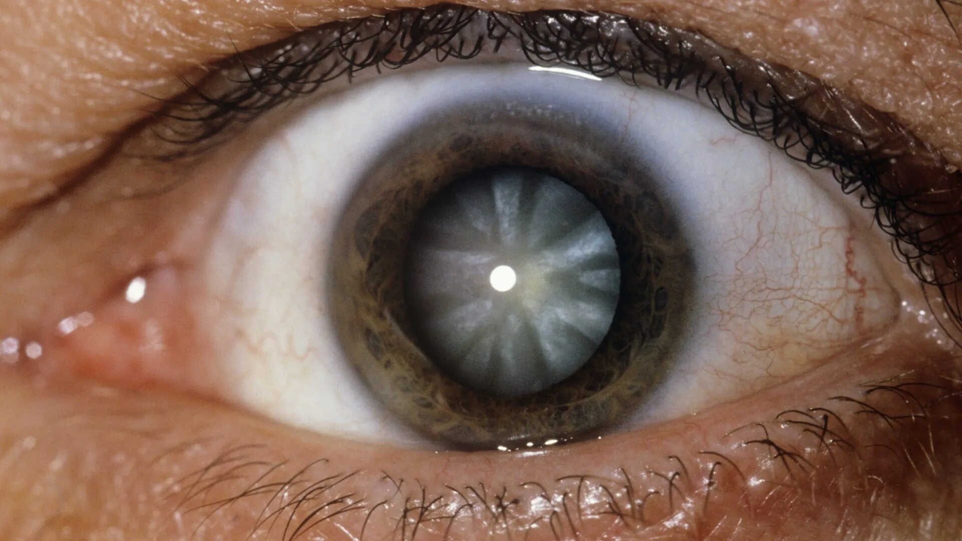 Контузионная катаракта. Тринитротолуоловая катаракта. Посттравматическая катаракта. Кольцевидная катаракта Фоссиуса.