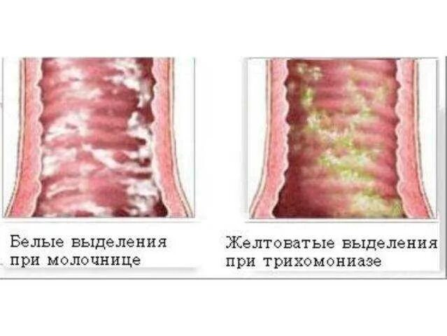 Может ли молочница быть признаком