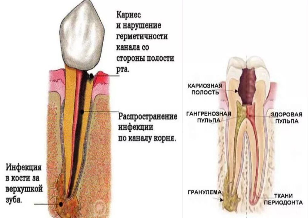 Воспаление корня зуба лечение