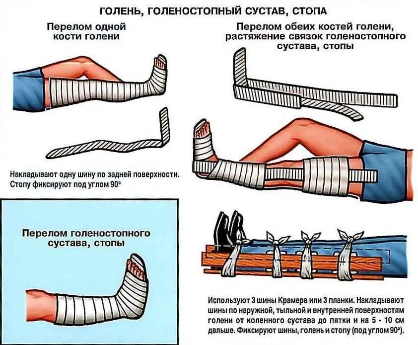 Перелом сустава первая помощь. Перелом голени иммобилизация. иммобилизация при переломе костей голени. шина крамера перелом костей голени. иммобилизирующая шина при переломе костей.