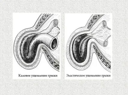 Защемленная грыжа