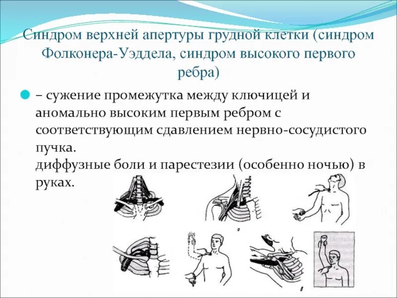 Синдром грудины. Синдром грудины. Tos синдром верхней апертуры грудной клетки. Характеристика кардиалгии. Синдром грудины.