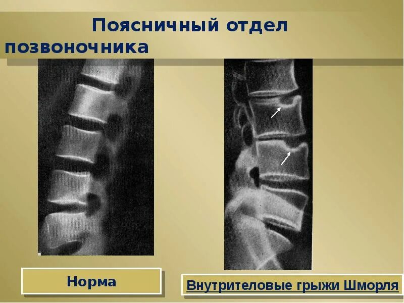 Остеохондроз позвоночника. Полисегментарный остеохондроз позвоночника что это. Остеохондроз презентация. Грыжа Шморля рентген.