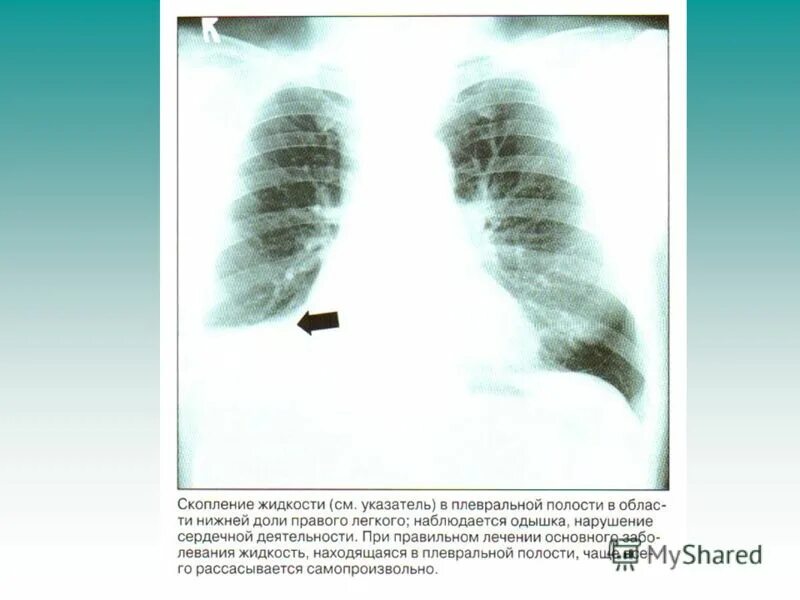жидкость в поджелудочной железе. локальное скопление жидкости. гидроторакс клинические симптомы. локальное скопление жидкости. локальное скопление жидкости.