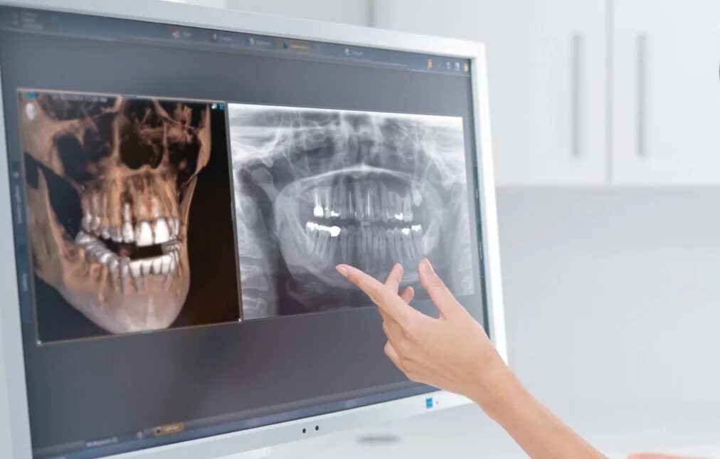 Кт зубов 3д Сирона. 3д КЛКТ челюсти. Кт 3д зубочелюстной системы. Конусная лучевая 3d компьютерная томография.