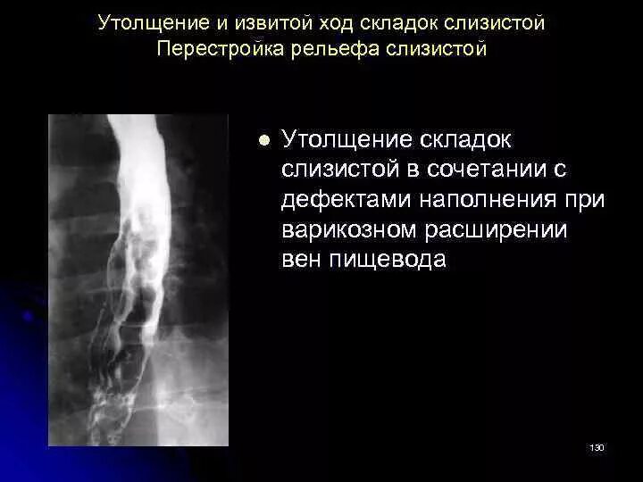 Пищевод складки слизистой. Расширение вен пищевода рентген. Утолщение складок пищевода рентген. Варикозно расширенные вены пищевода рентген. Утолщение складок желудка рентген.