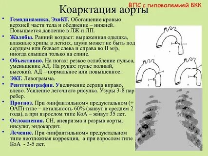 Тест коарктация аорты по утвержденным
