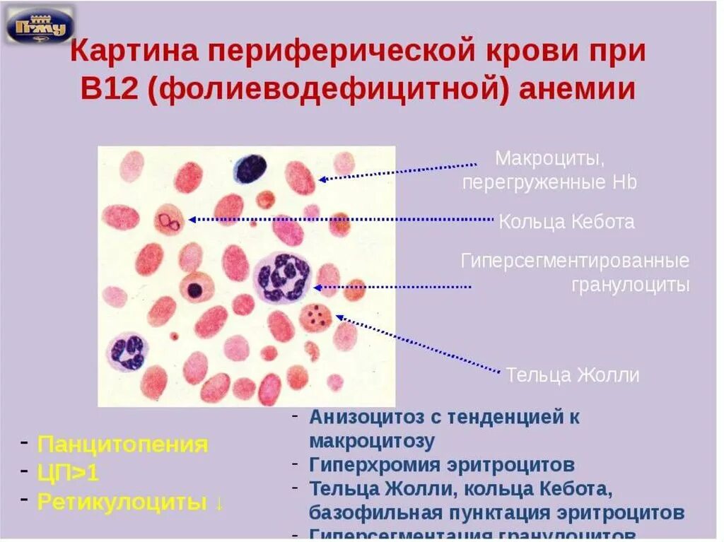 Картина крови при в12 дефицитной. В12 фолиеводефицитная анемия картина крови. Морфологические изменения при в12 дефицитной анемии. В12 дефицитная анемия мазок крови. Патологические клетки крови не обнаружены