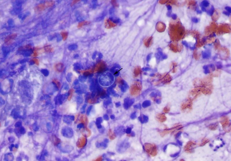 Многочисленные мелкие тельца. Бластомикоз североамериканский. Бластомикоз микробиология. Бластомикоз гистоплазмоз возбудитель. Бластомикоз микроскопия.