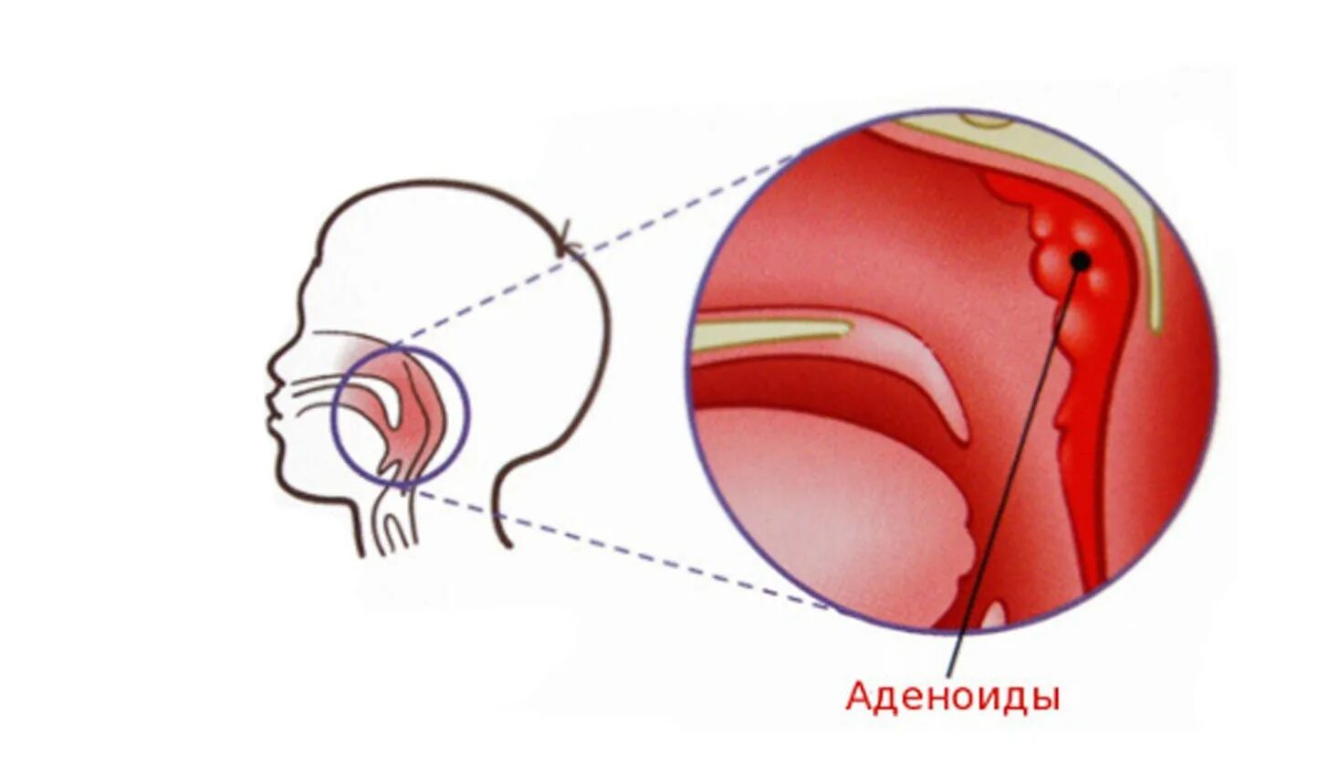 Аденоидные вегетации 1