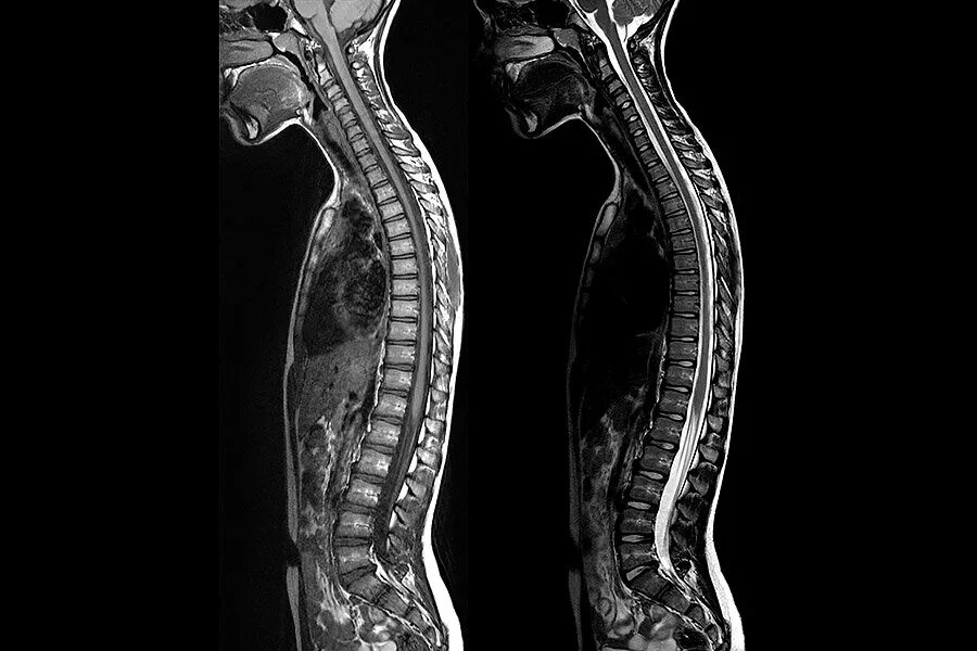 Рентген здорового позвоночника сбоку. Сагиттальный срез мрт позвоночника. Рентген кт мрт позвоночника. Мрт грудного отдела позвоночника.