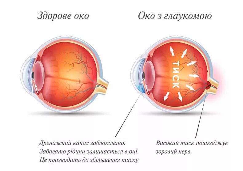 Заболевание глаз глаукома.