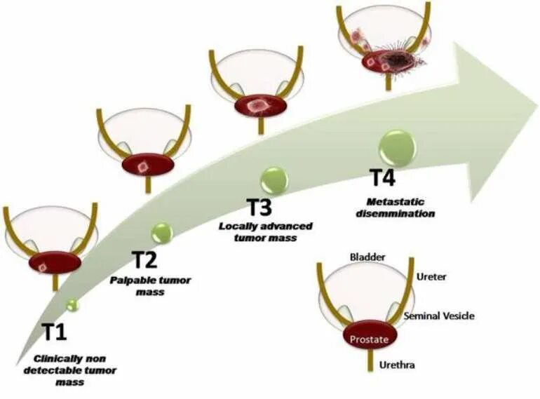 Advanced tumor