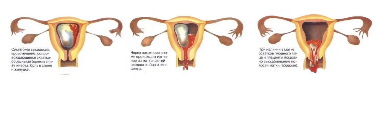 Самопроизвольный выкидыш. Выкидыш на раннем сроке плодное яйцо. Неполный самопроизвольный выкидыш. Симптомы после выкидыша.