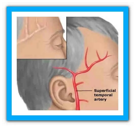 Что будет если ударить в висок. Пульсация жилки на Виске. Весок ООИТ. Пульсирующая артерия на Виске. Пульсирует в Виске справа.