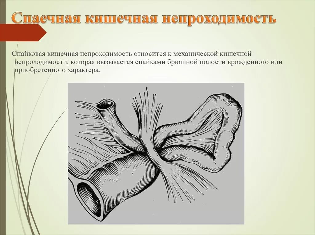 Острая кишечная непроходимость спайки. Острая странгуляционная спаечная непроходимость. Спаячная инвагинация у детей. Острая спаечная кишечная непроходимость операция.