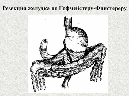Бильрот 2 в модификации