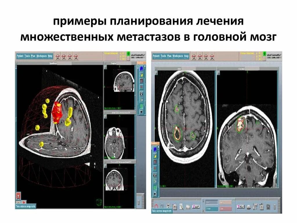 Лечение метастазов мозга. Множественные метастазы в мозге. Стереотаксическая радиохирургия. IMRT при множественных метастазах в головном мозге.