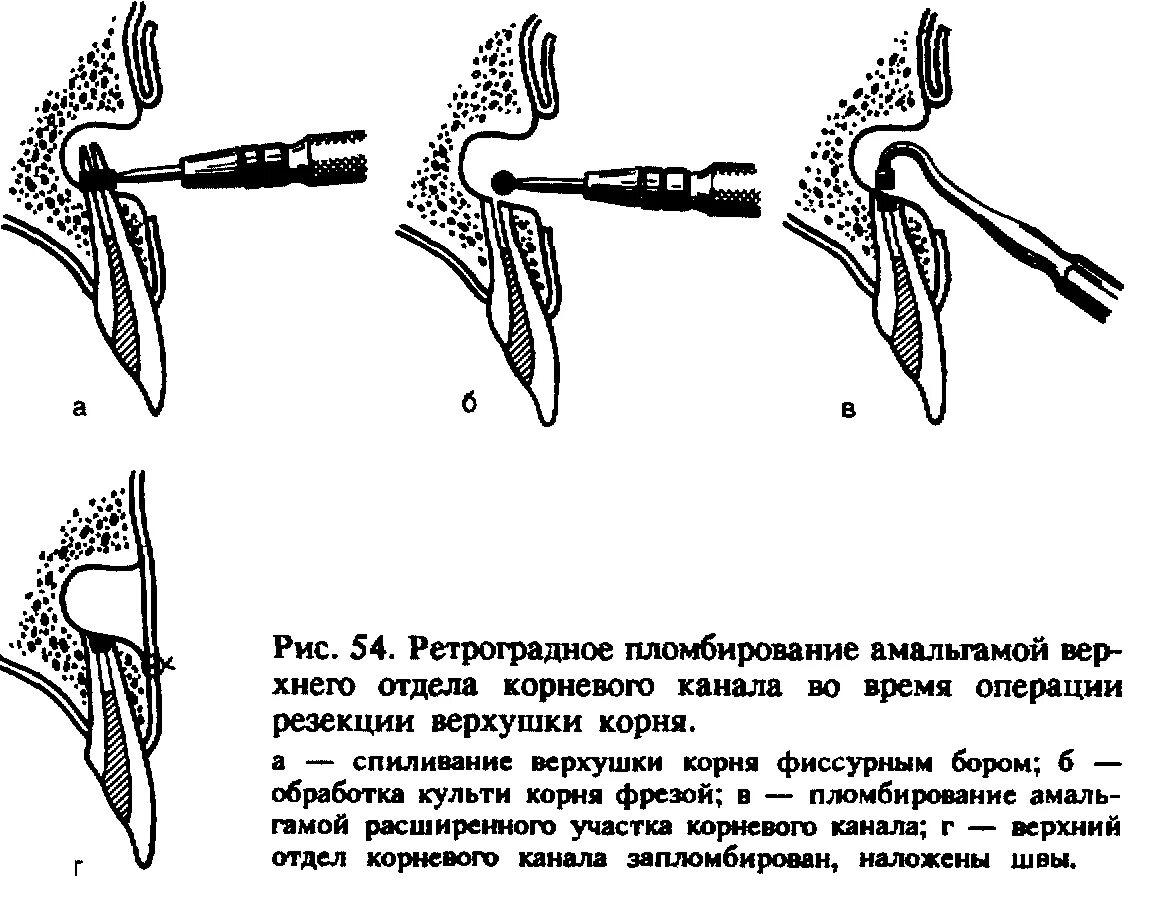 Резекция верхушки корня зуба с ретроградным пломбированием. Ретроградное пломбирование верхушки корня. Резекция верхушки корня с ретроградным пломбированием. Методика проведения операции резекции верхушки корня зуба. Цистоэктомия