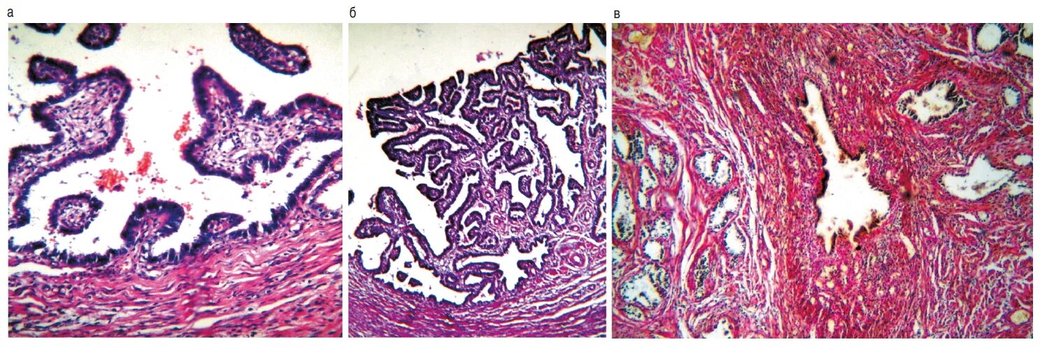 Гистология при беременности. Внематочная беременность гистология. Атрофия эндометрия гистология. Трубная беременность гистология.