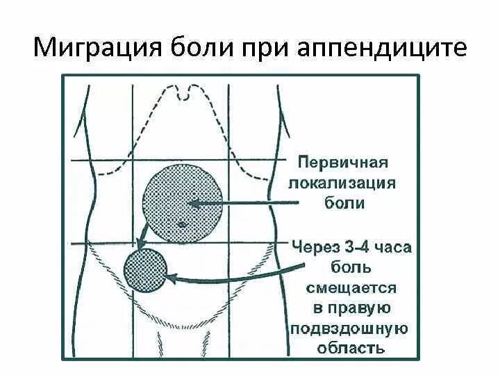 Боли в животе при остром аппендиците