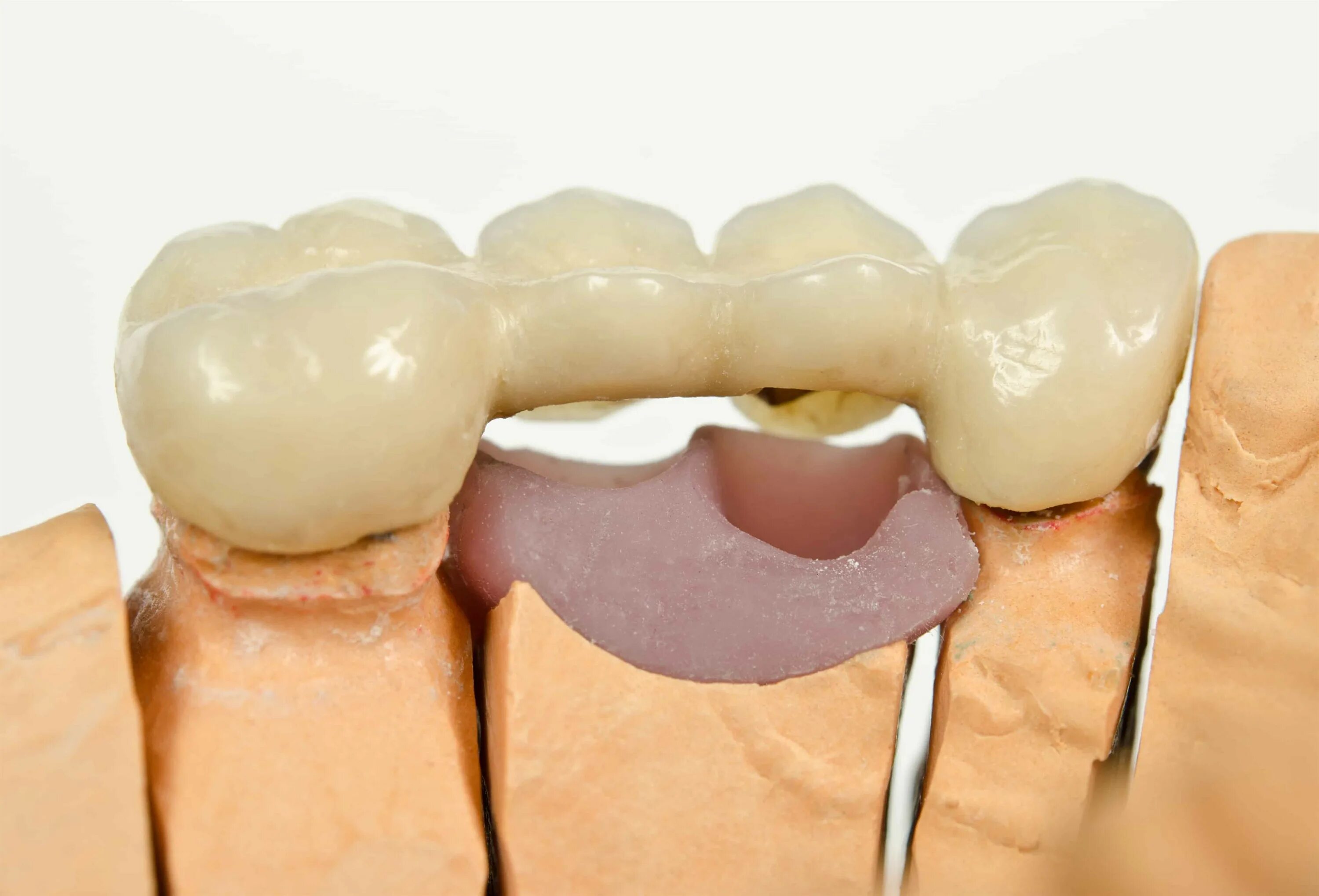 Мостовидный зубной протез несъемный. Импланты жевательных зубов. Мостовидные несъемные зубные. Мост на зуб форум. Мостовидный протез на 2 имплантах.