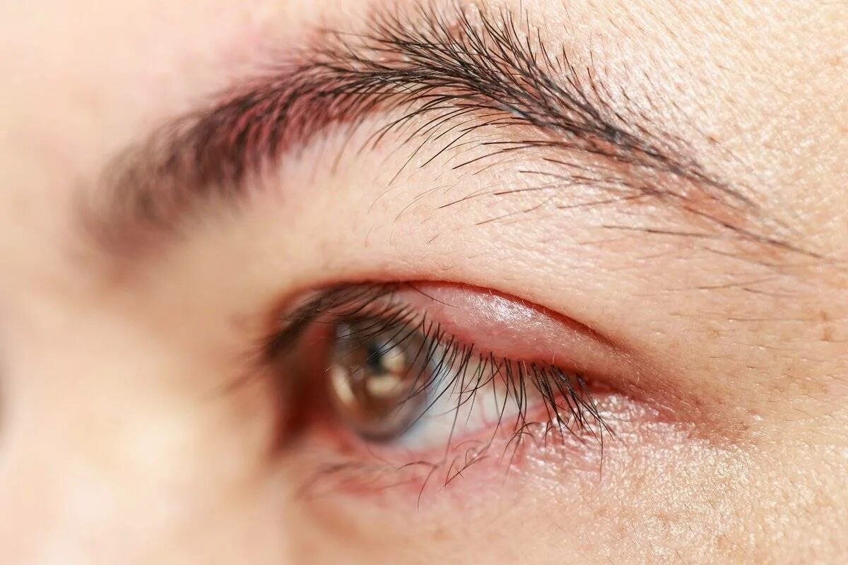 Народное лечение ячменя. Блефарит демодекозный глаза.