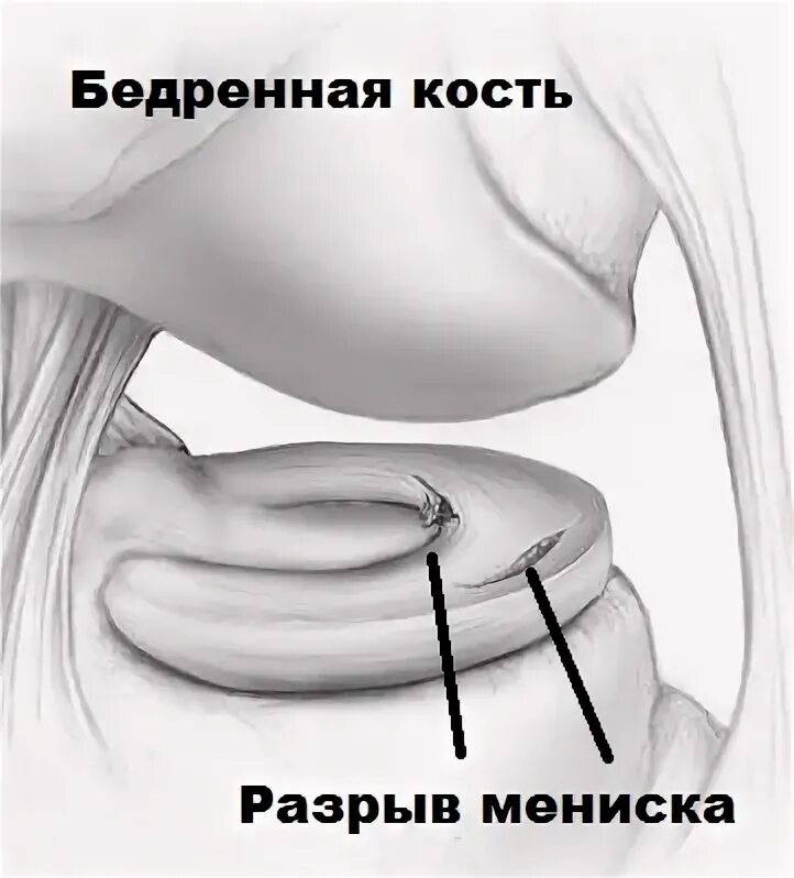 Сшив мениска. Артроскопический шов медиального мениска. повреждение мениска коленного сустава. разрыв мениска коленного сустава. колен сустав разрыв мениск.