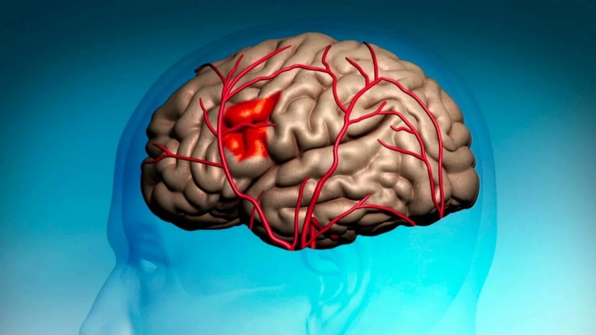 Имеет крови мозга и. Поражение головного мозга. Локальные поражения мозга. Ишемическое поражение мозга.