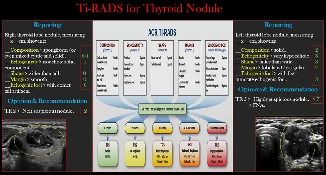 Ti rads щитовидной железы. Классификация Tirads щитовидная железа. Tirads 2 щитовидная железа. Классификация ti-rads для УЗИ. O rads 4