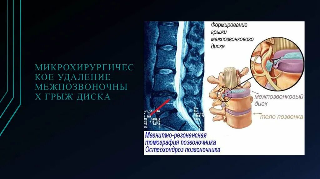 Секвестрированная грыжа позвонка. Секвестрация грыжи межпозвоночного диска что это такое. Фораминальная грыжа диска. Грыжа межпозвонкового диска операция. Удаления грыжи позвоночника поясничного отдела отзывы